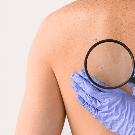 skin cancer removal gold coast