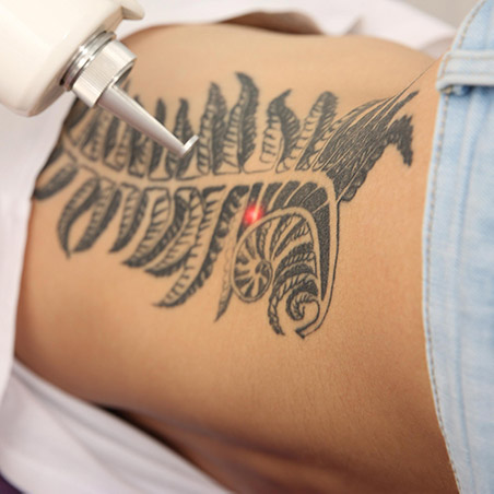 tattoo removal gold coast