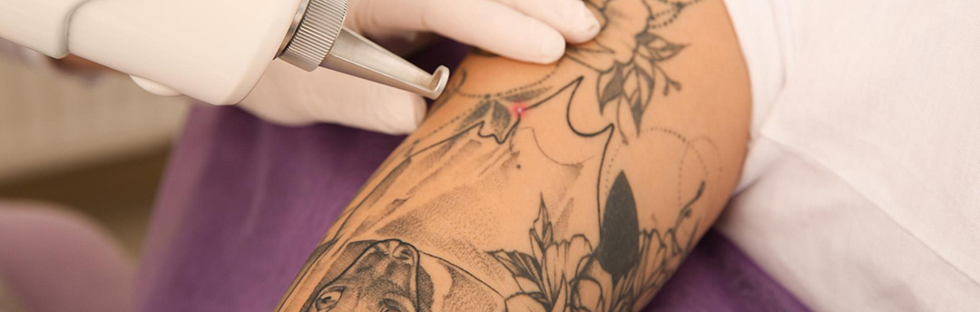Laser Tattoo Removal In Milton Keynes  Tattoo Transparent PNG  721x1000   Free Download on NicePNG